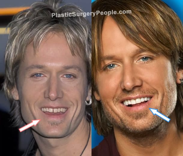 Keith Urban teeth before and after photo