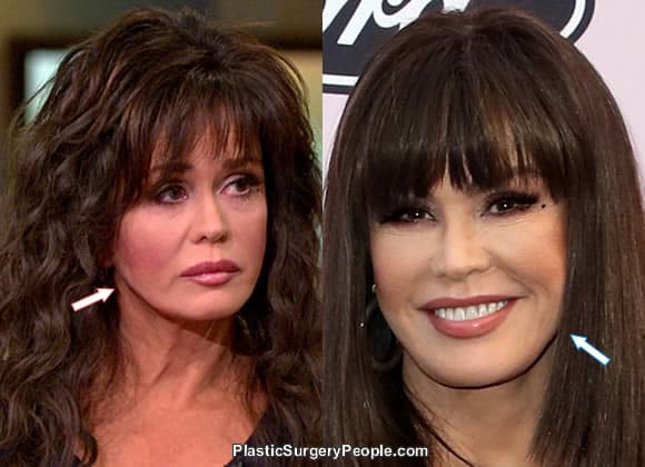 Did Marie Osmond have botox and a facelift?