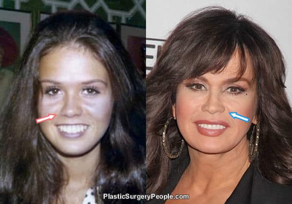 Did Marie Osmond have a nose job?