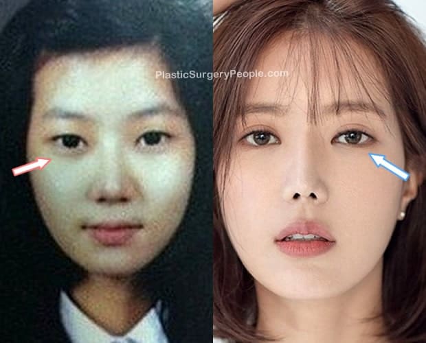 Did Im Soo Hyang have eyelid surgery?