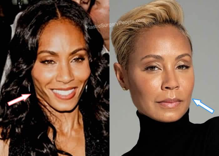 Jada Pinkett Smith facelift before and after photo