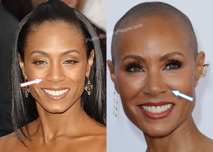 Jada Pinkett Smith nose job before and after photo