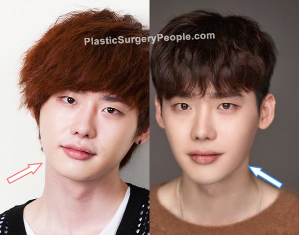 Lee Jong Suk botox before and after photo