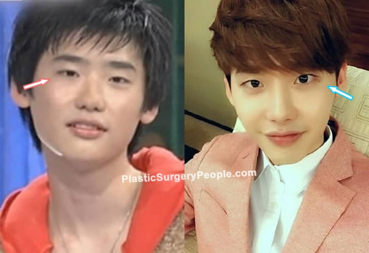 Lee Jong Suk eye surgery before and after photo
