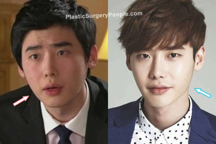 Lee Jong Suk jaw reduction before and after photo