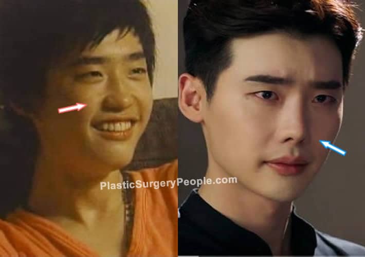 Lee Jong Suk nose job before and after photo