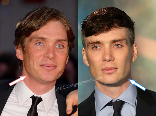 Cillian Murphy facelift before and after photo