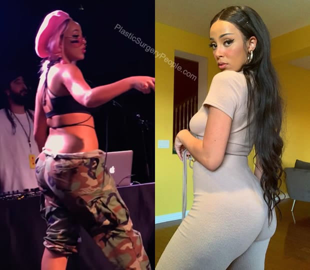 Doja Cat butt lift before and after photo