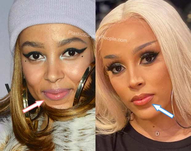 Doja Cat lip fillers before and after photo