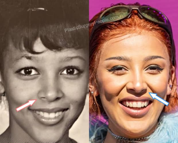 Doja Cat nose job before and after photo