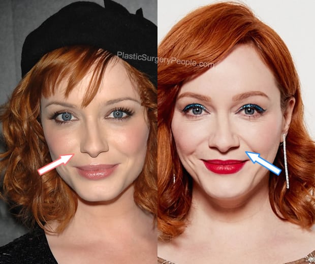 Christina Hendricks nose job before and after photo