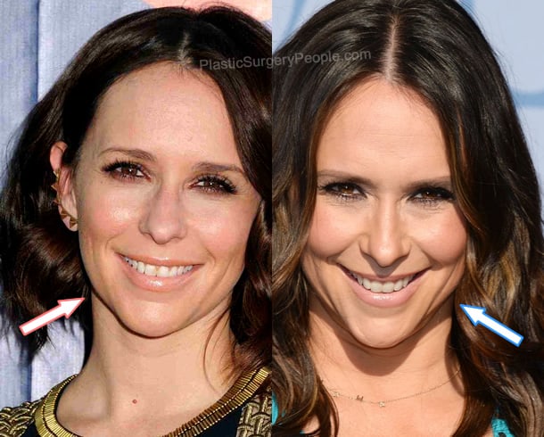 Jennifer Love Hewitt botox before and after photo