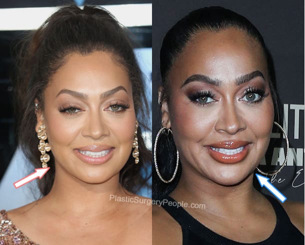 Lala Anthony botox before and after photo