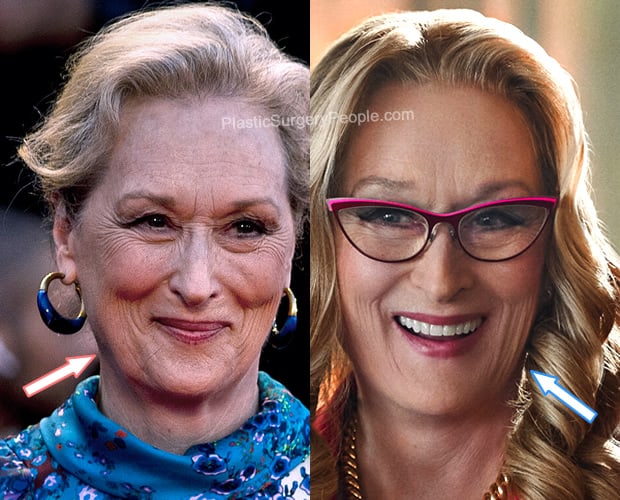 Meryl Streep botox before and after photo