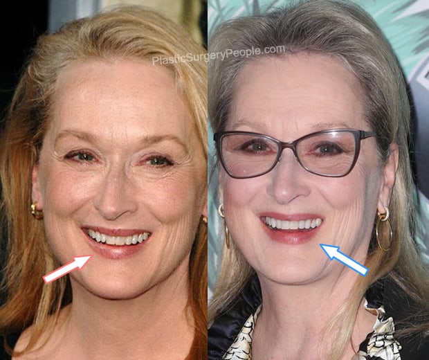 Meryl Streep teeth before and after photo