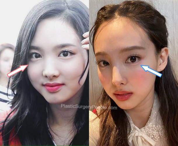 Nayeon eye surgery before and after photo