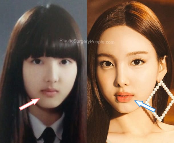 Nayeon lip fillers before and after photo