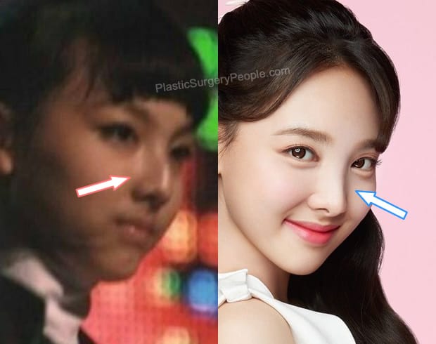 Nayeon nose job before and after photo