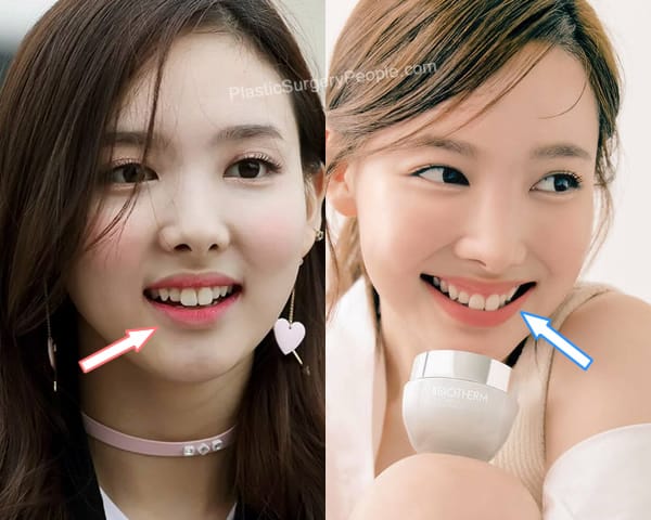 Nayeon teeth before and after photo