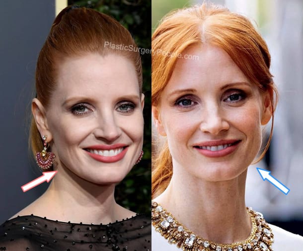Jessica Chastain botox before and after photo