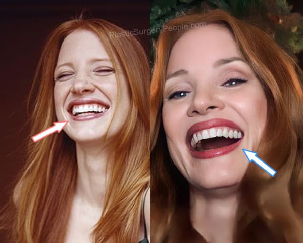 Jessica Chastain teeth before and after photo