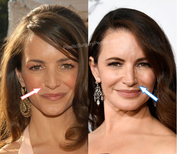 Kristin Davis nose job before and after photo
