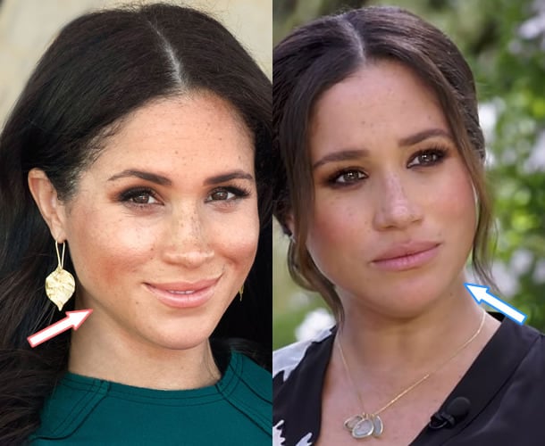 Meghan Markle botox before and after photo