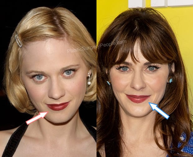 Zooey Deschanel lip injections before and after photo