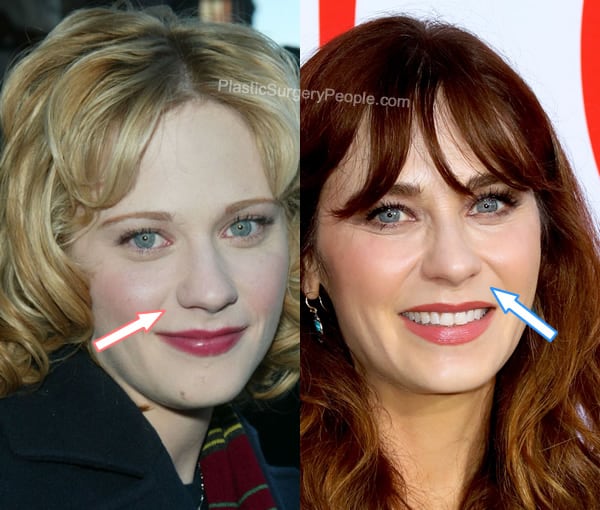 Zooey Deschanel nose job before and after photo