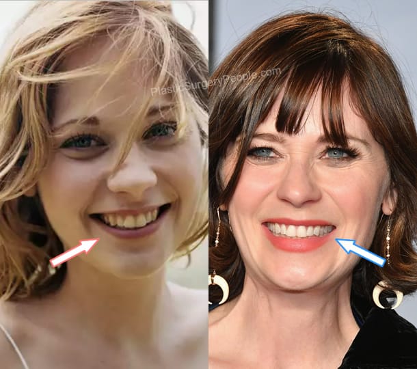 Zooey Deschanel teeth before and after photo
