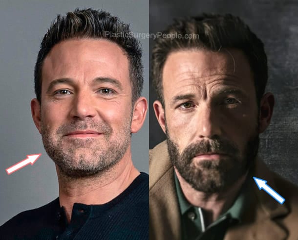 Ben Affleck botox before and after photo