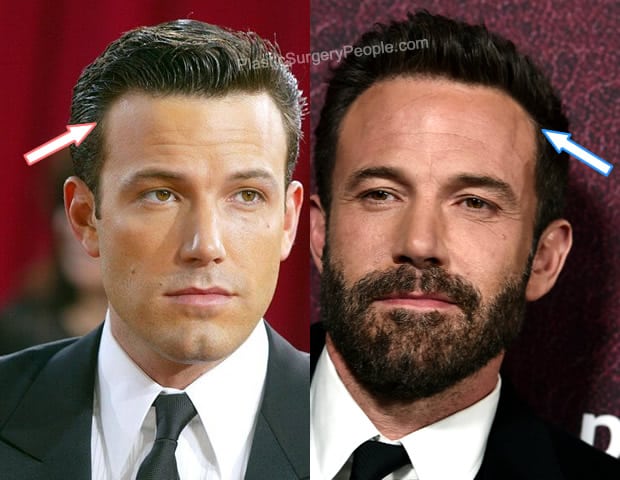 Ben Affleck hair transplant before and after photo