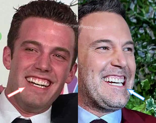 Ben Affleck teeth before and after photo