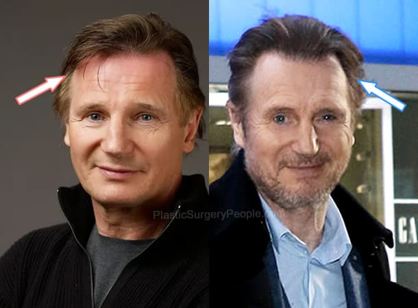 Liam Neeson hair transplant before and after photo