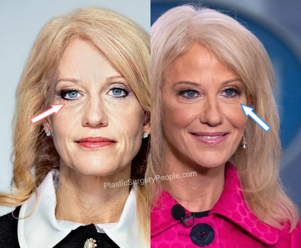 Kellyanne Conway eyelift before and after photo