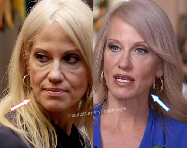 Kellyanne Conway facelift before and after photo comparison