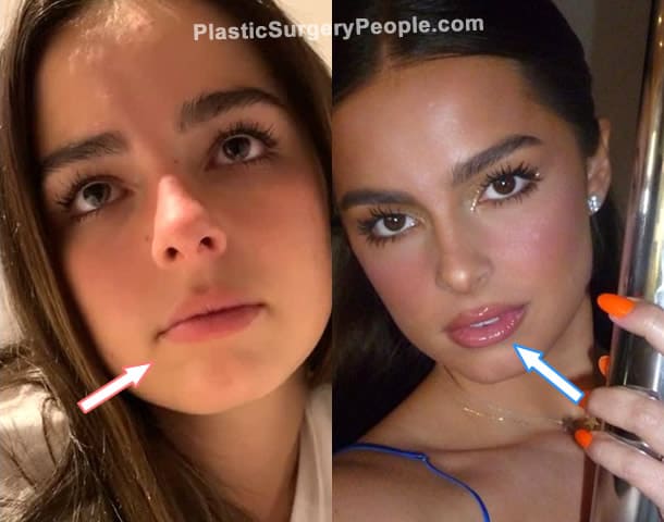 Addison Rae lip injections before and after photo