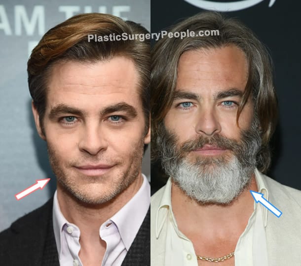 Chris Pine facelift before and after photo