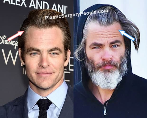 Chris Pine hair transplant before and after photo