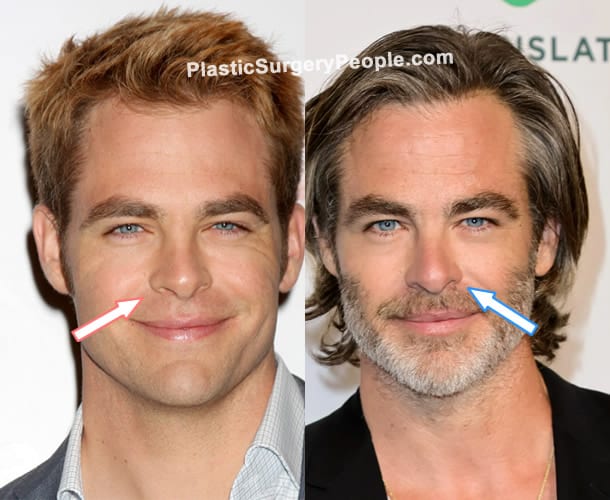 Chris Pine nose job before and after photo