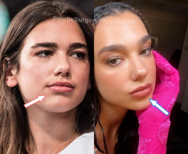 Dua Lipa lip fillers before and after photo