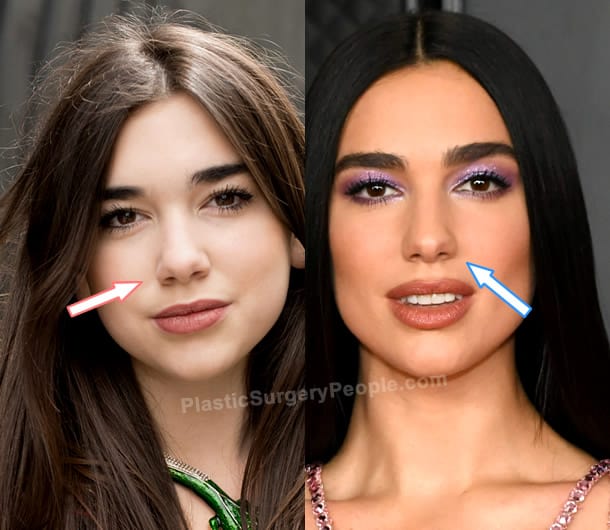 Dua Lipa nose job before and after photo