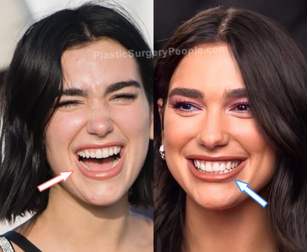 Dua Lipa teeth before and after photo