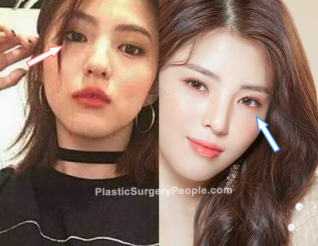 Han So Hee eyelid surgery before and after photo