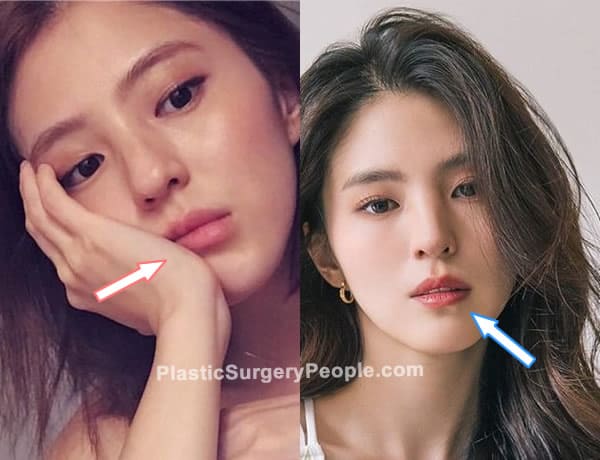 Han So Hee lip fillers before and after photo