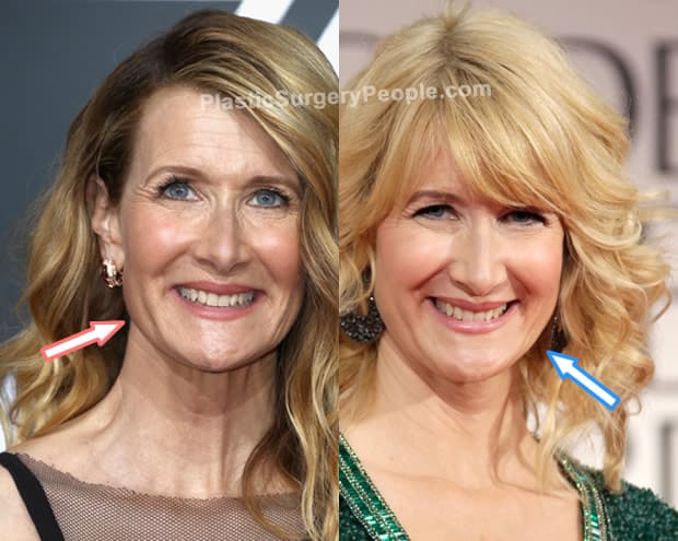 Laura Dern botox before and after photo