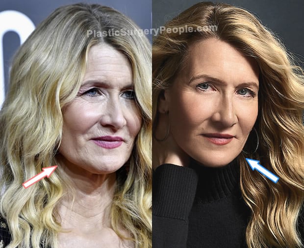 Laura Dern facelift before and after photo