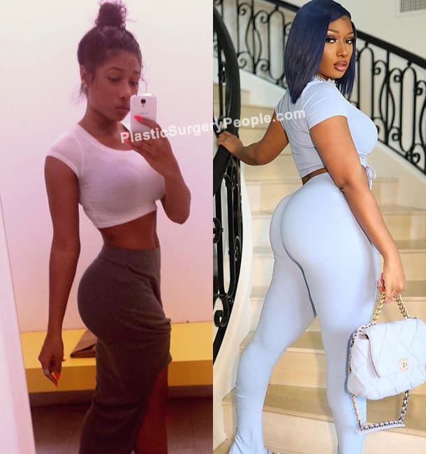 Megan Thee Stallion butt lift before and after photo