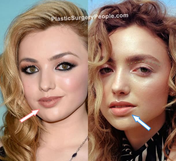 Peyton List lip fillers before and after photo