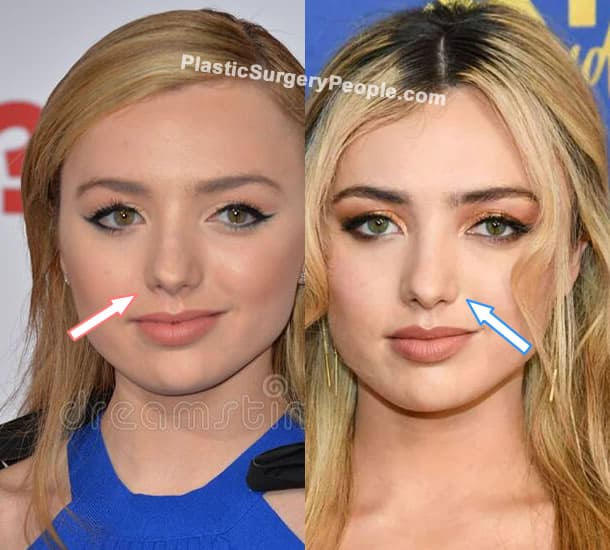 Peyton List nose job before and after photo